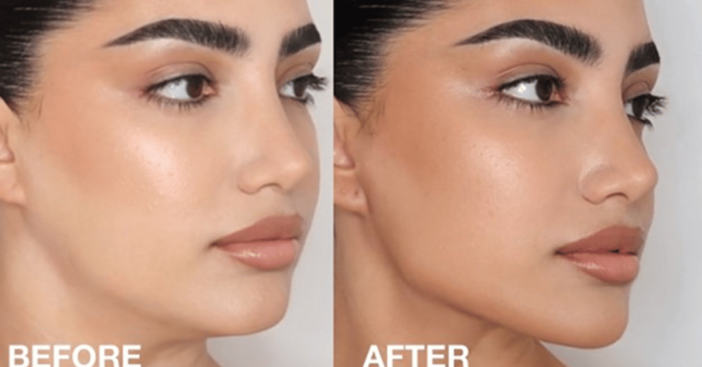 Jawline Contouring