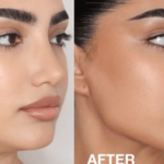 Jawline Contouring