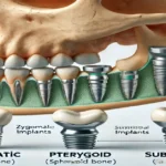 Zygomatic