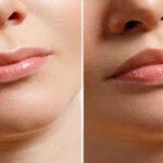 Lip Flip Before and After