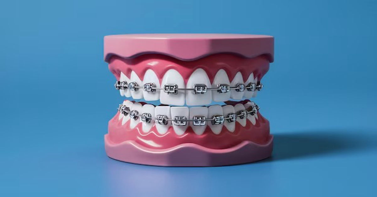 How Much Are Braces