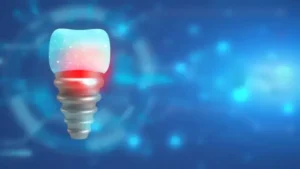 Subperiosteal Implant